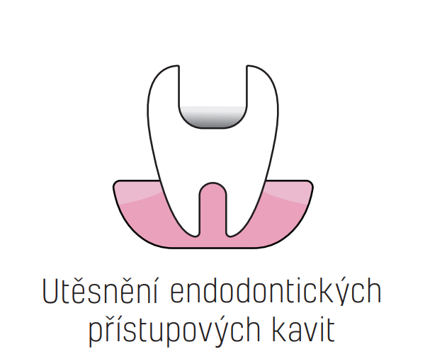Indikace Systému Stela - Utěsnění endodontických přístupových kavit